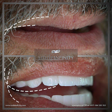 Z-Evolution No-Prep Veneers — All-Inclusive Beirut Experience