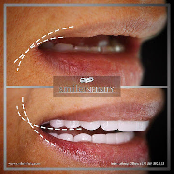 Z-Evolution No-Prep Veneers — All-Inclusive Beirut Experience