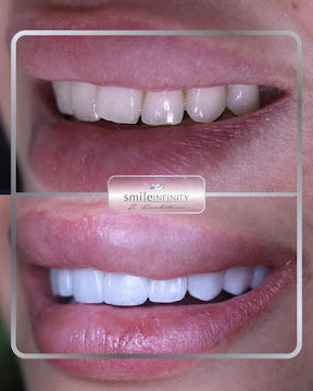 Z-Evolution No-Prep Veneers — All-Inclusive Beirut Experience
