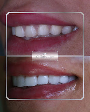 Z-Evolution No-Prep Veneers — All-Inclusive Beirut Experience